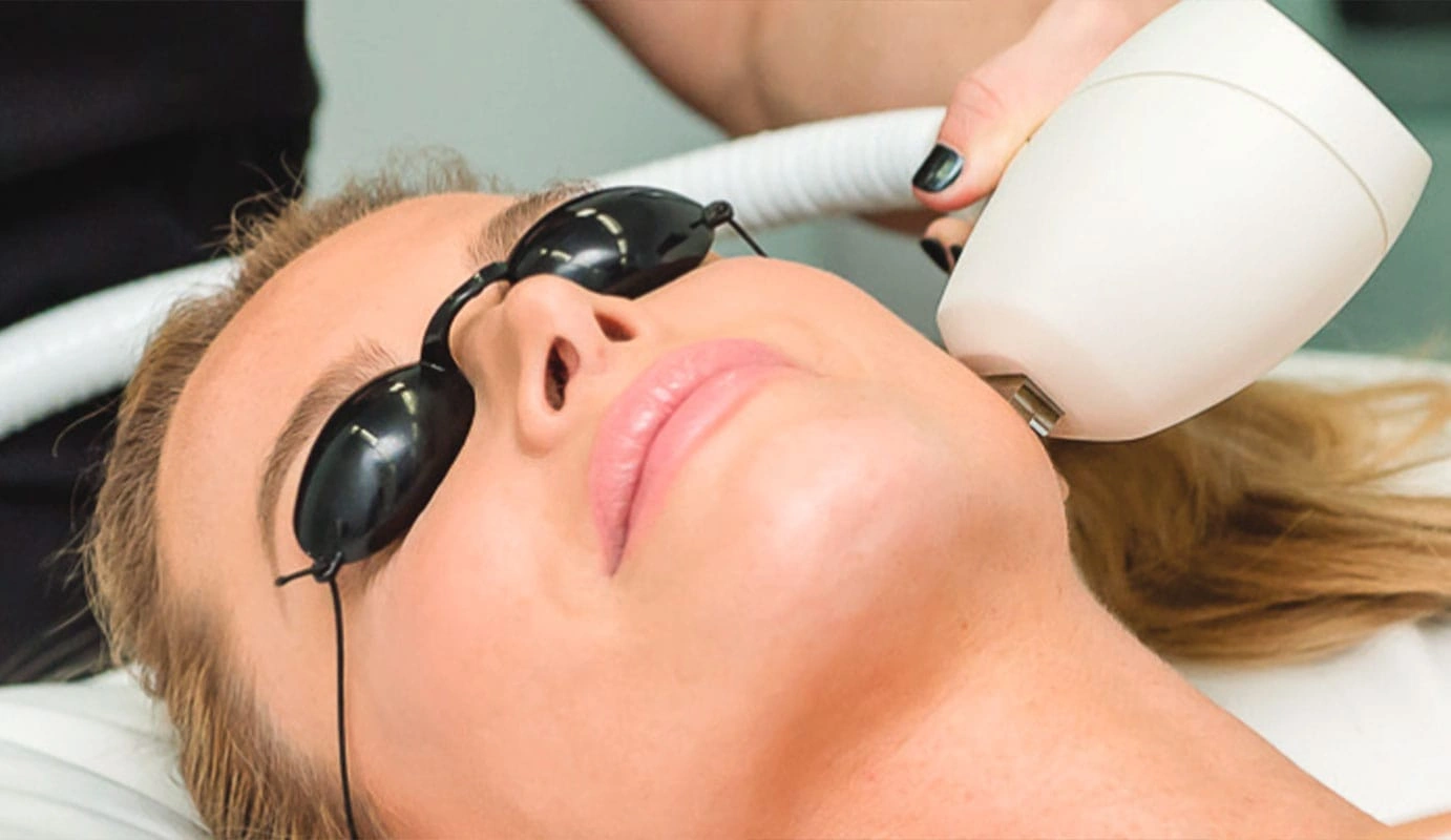 Photofacial treatment showcase