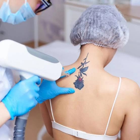 Tattoo removal treatment showcase