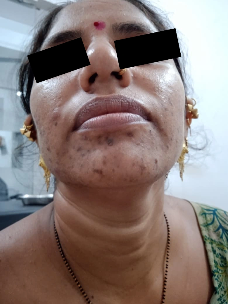 Acne Marks Treatment treatment result - before