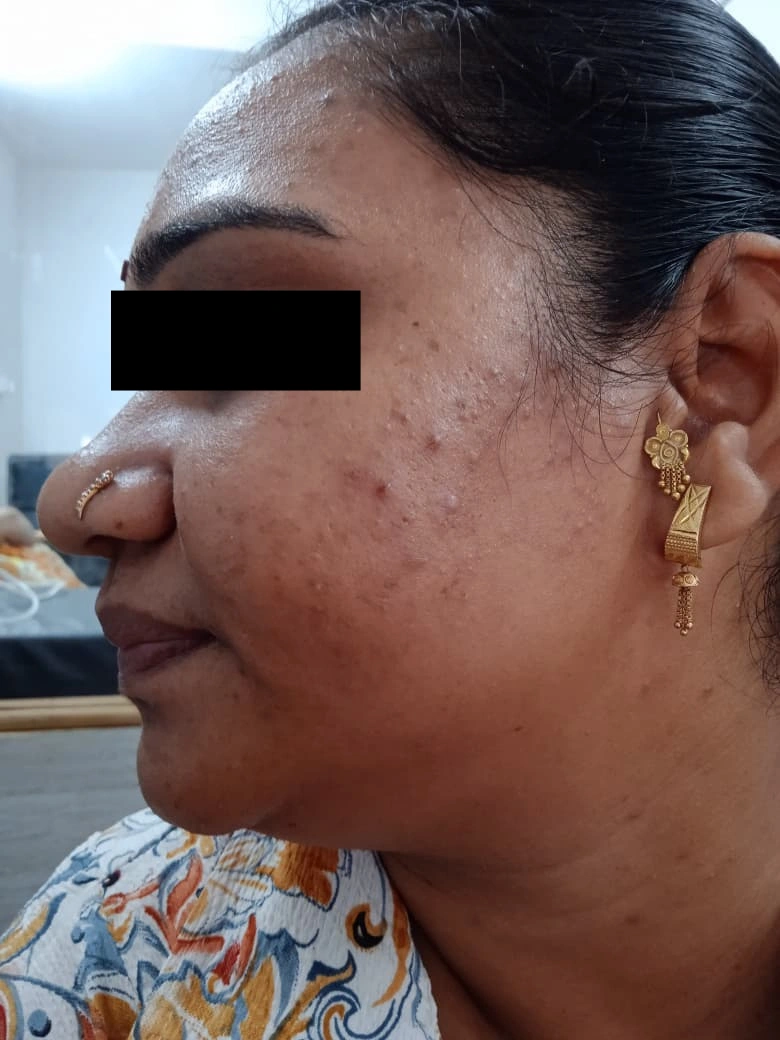 Acne Treatment treatment result - before