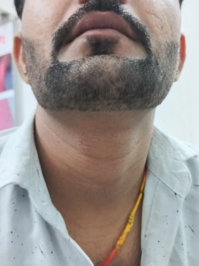 Alopecia Areata treatment result - after
