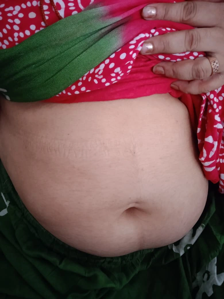 Erythema Multiforme treatment result - after