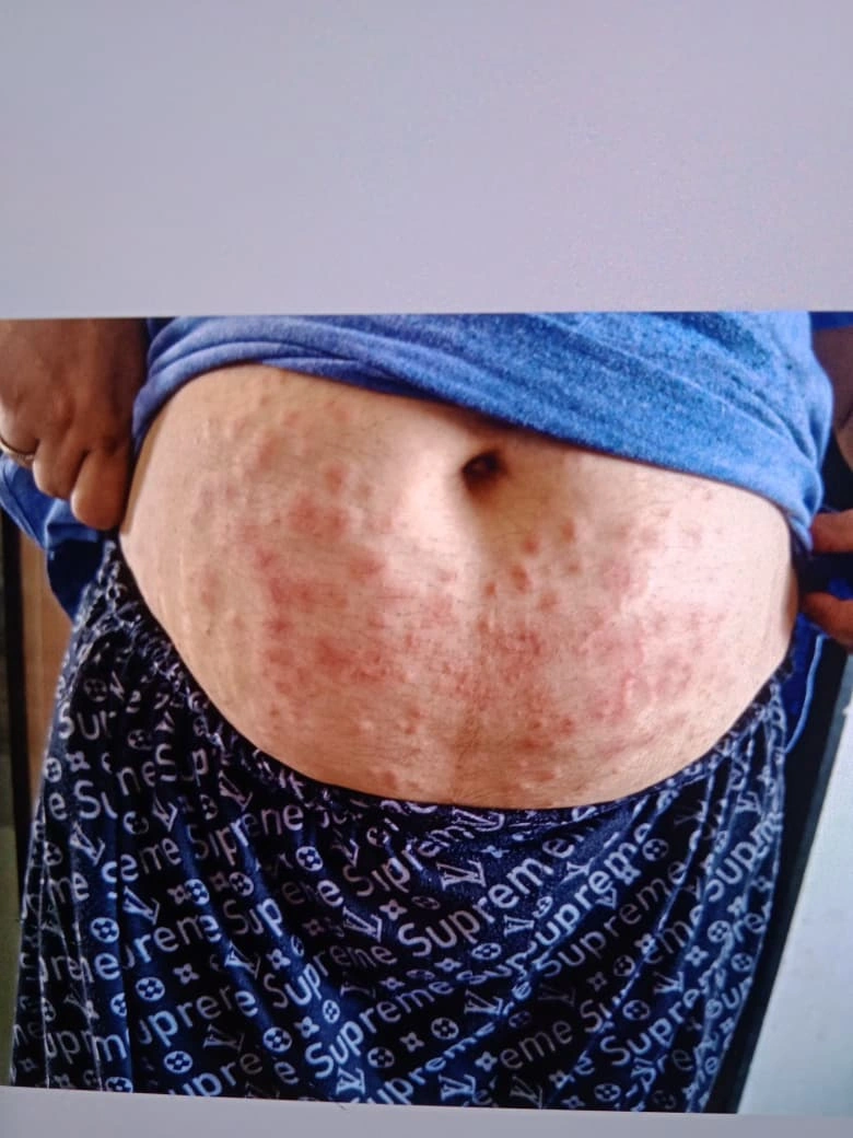 Erythema Multiforme treatment result - before