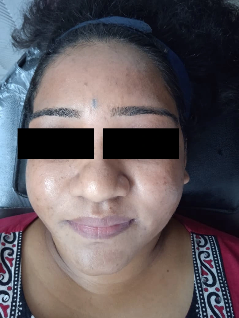 Hydrafacial treatment result - after