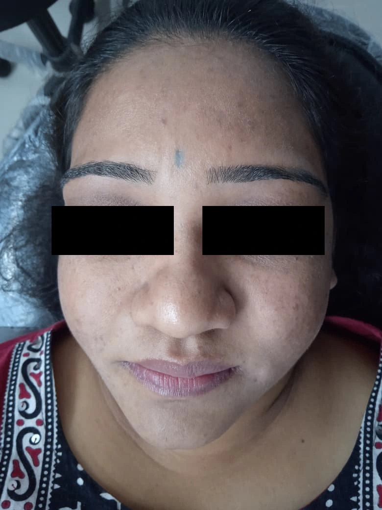 Hydrafacial treatment result - before