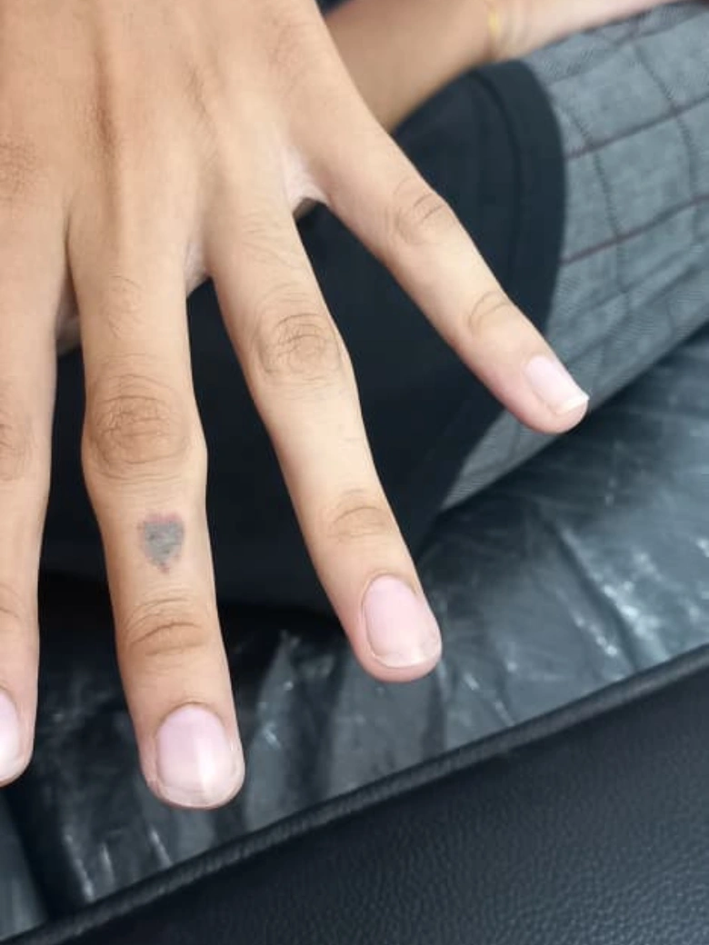Tattoo Removal treatment result - before